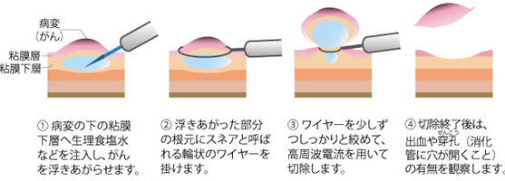 内視鏡的粘膜切除術(EMR)