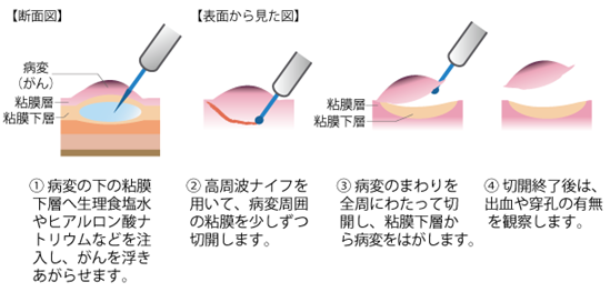 内視鏡的粘膜下層剥離術(ESD)