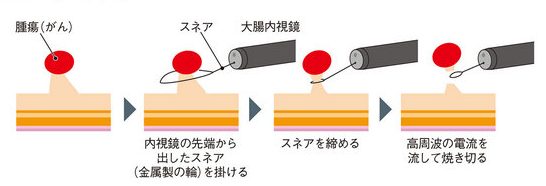 内視鏡的ポリープ切除術(ポリペクトミー)