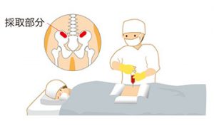 骨髄採取