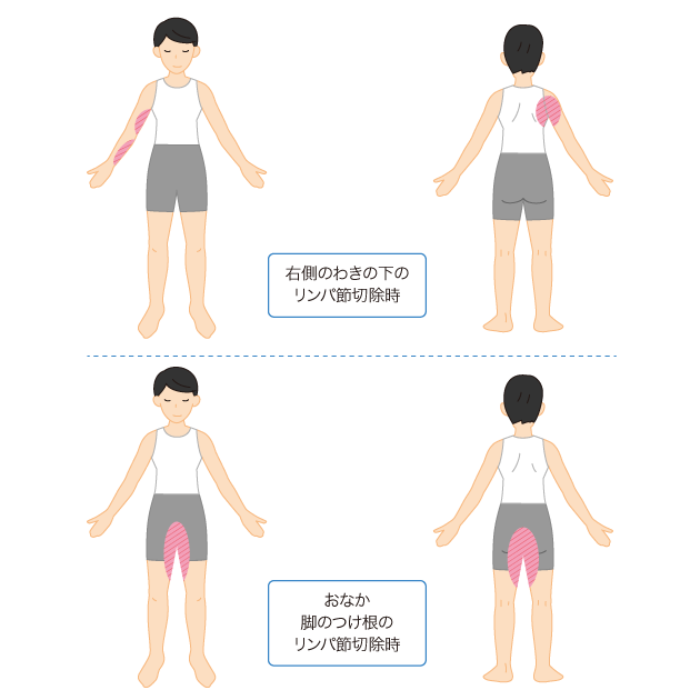 がんの手術後の初期にリンパ浮腫になりやすい場所