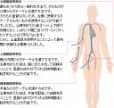 カテーテル