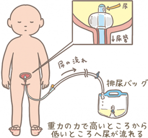 尿道カテーテル
