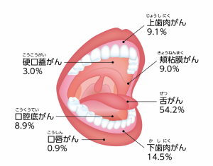 口腔がん