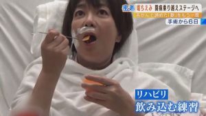 舌がん手術後の嚥下トレーニング