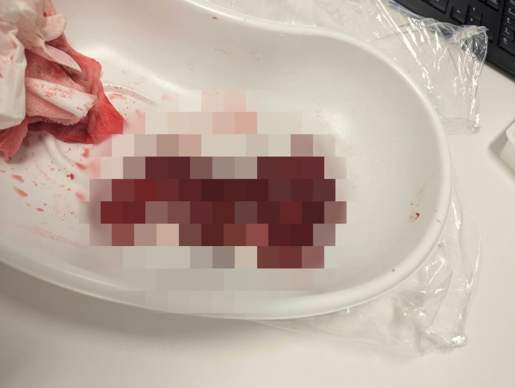 腫瘍切除部