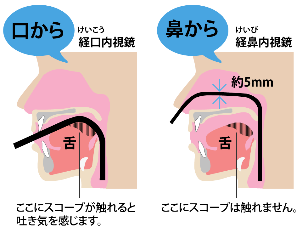 経鼻内視鏡と経口内視鏡の違い